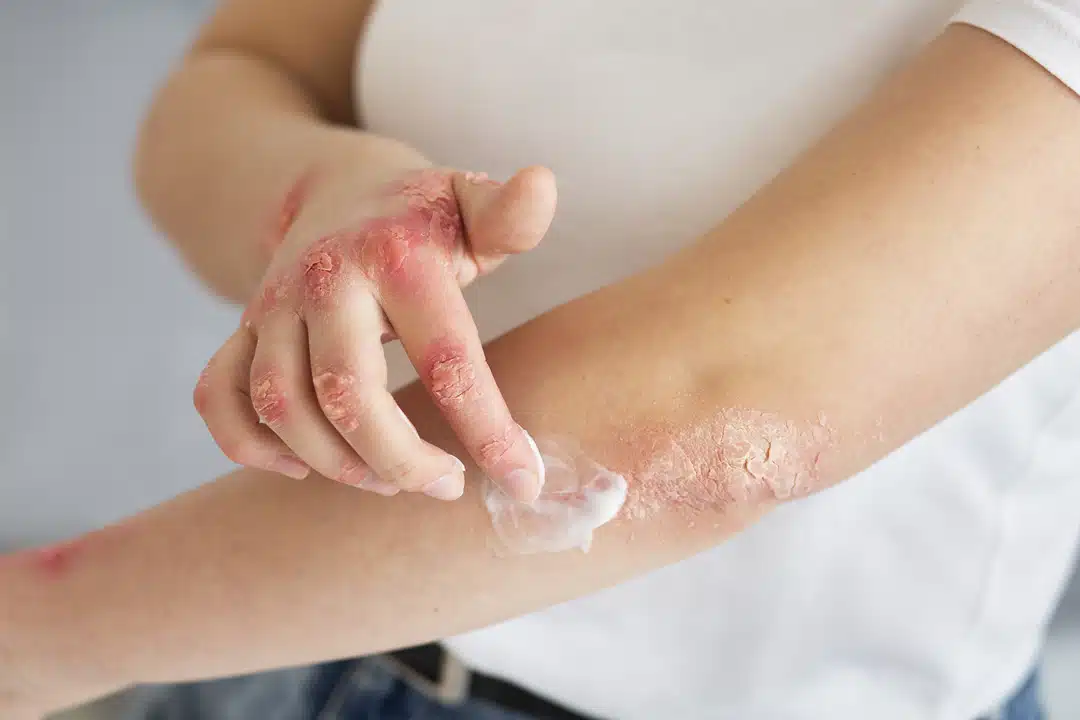 peau-sensible-hands-patient-suffering-from-psoriasis